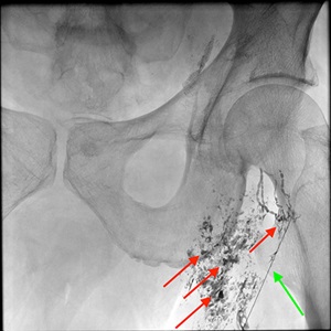 Inguinal lymph nodes for TD access